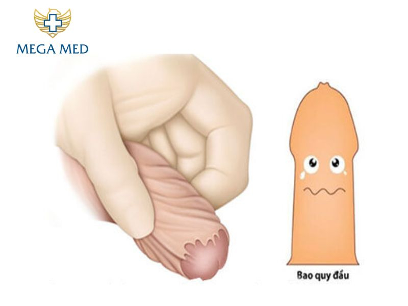 lột bao quy đầu tại nhà